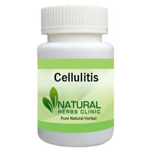 Herbal Supplements for Cellulitis