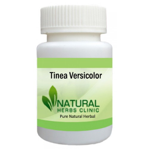 Herbal Supplements for Tinea Versicolor