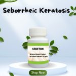 Apple Cider Vinegar Treatment for Seborrheic Keratosis