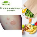 Granuloma Annulare and Diet