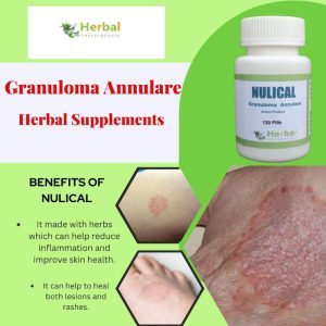 HerbalSupplementsforGranulomaAnnulare