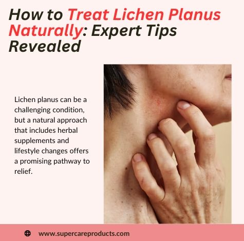 How to Treat Lichen Planus Naturally 12