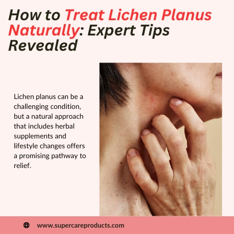 How to Treat Lichen Planus Naturally: Expert Tips Revealed