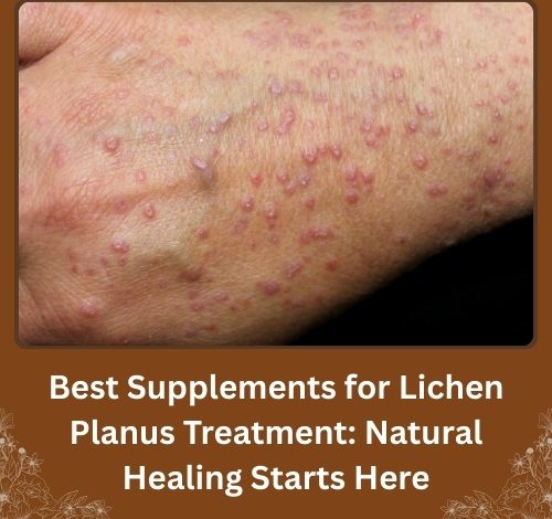 Best Supplements for Lichen Planus Treatment: Natural Healing Starts Here